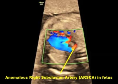ANOMALOUS right subclavian artery