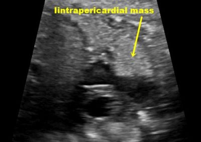 INTRAPERICARDIAL MASS