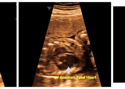 LV ANEURYSM