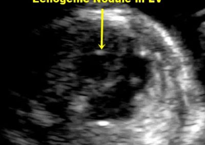 LV ECHOGENIC NODULE