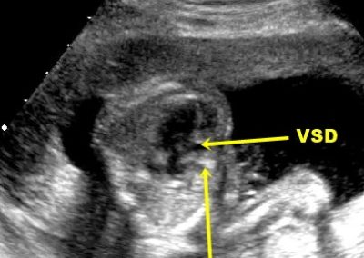 Tricuspid Atresia (TA) VSD