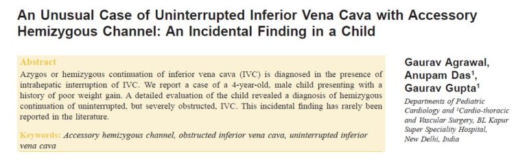 An Unusual Case of Uninterrupted Inferior Vena Cava with Accessory Hemiazygous Channel