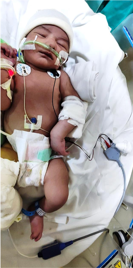 Balloon Atrial Septostomy - 16 days old blue baby
