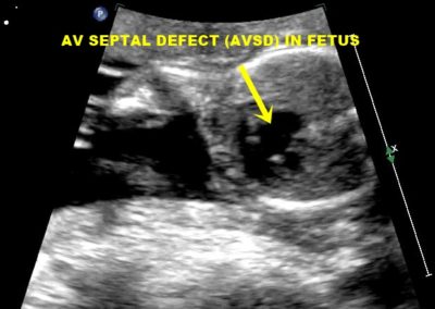 Atrio-ventricular Septal Defect (AVSD)