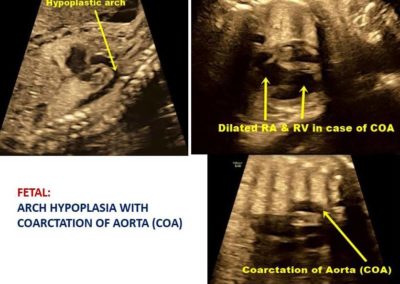 Coarctation of Aorta (COA)