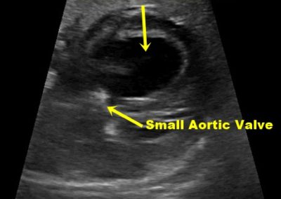 Dilated LV Small Aortic Annuus